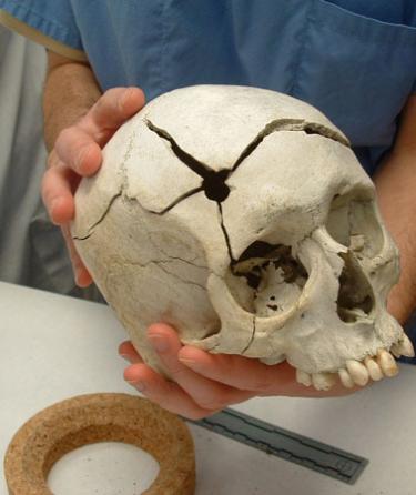 Skull with a round defect